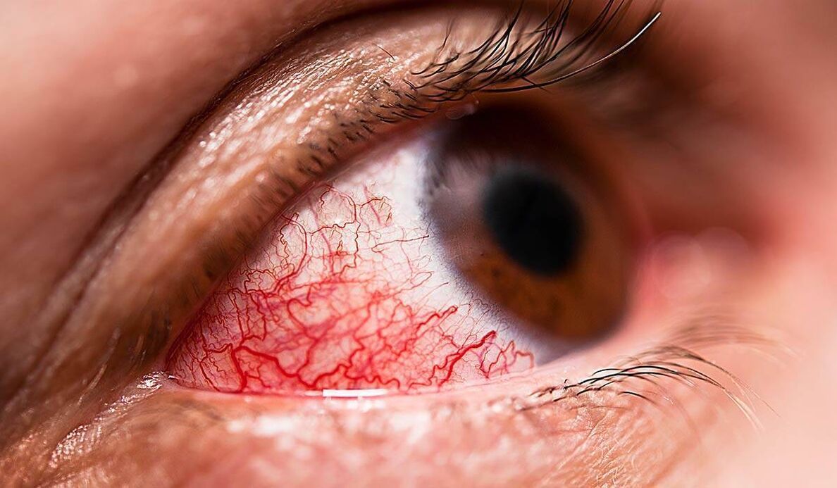 A diabéteszes retinopathia a cukorbetegség egyik késői szövődménye